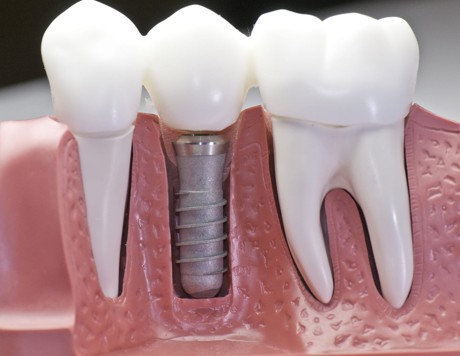 Dental Implants in Ukiah