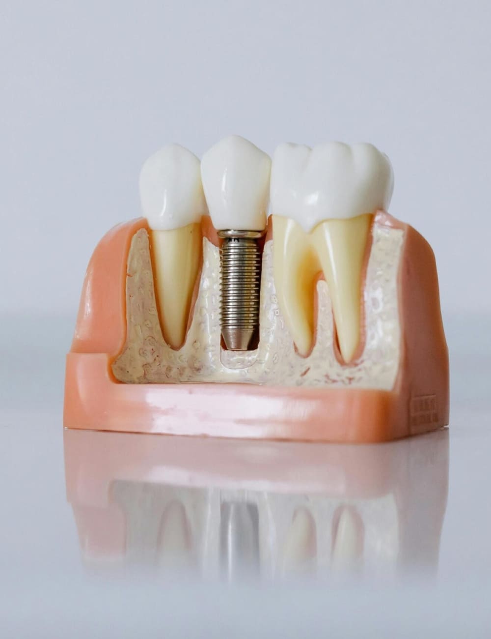 Dental Implants