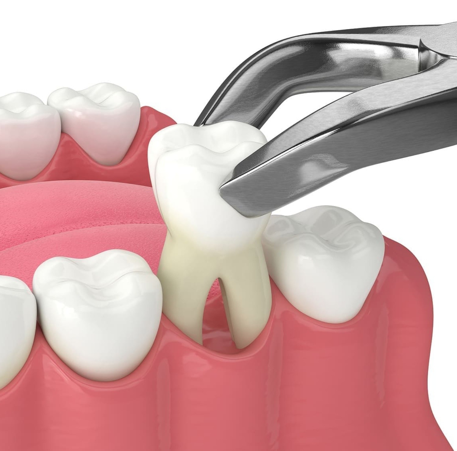 tooth-extraction-in-ukiah