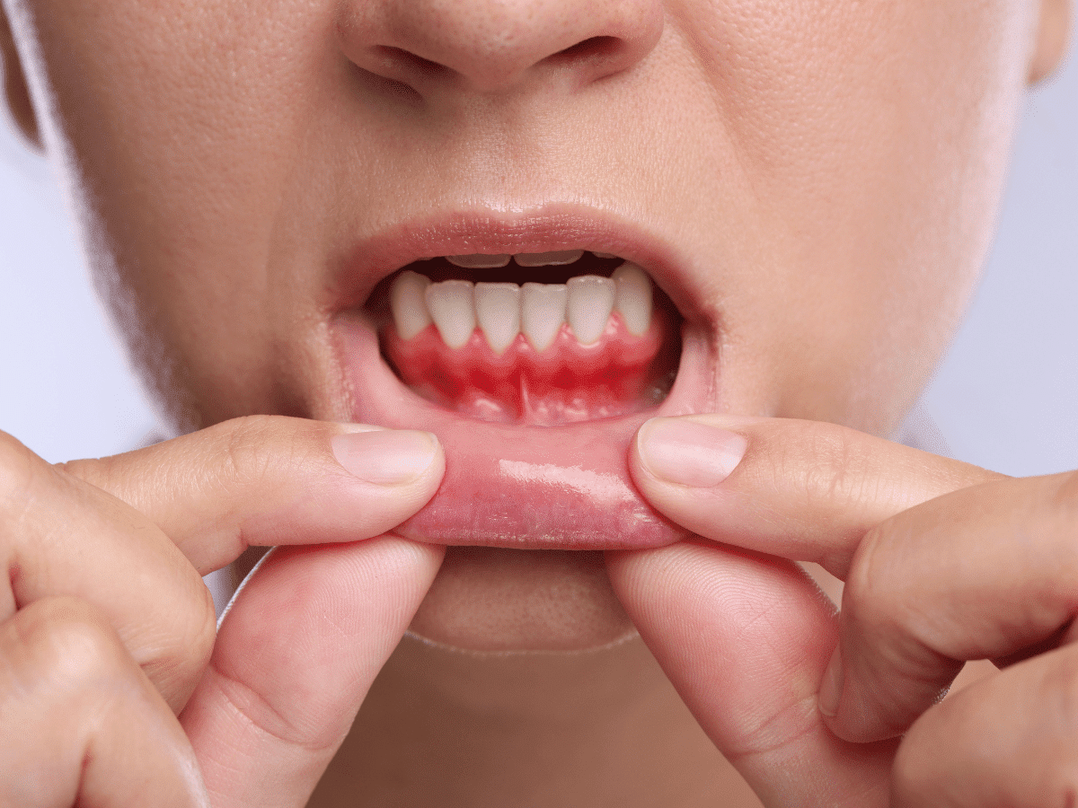 Person experiencing bleeding gums during brushing