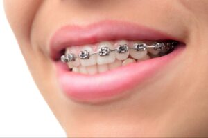 Adult smiling with braces during orthodontic treatment in Ukiah CA