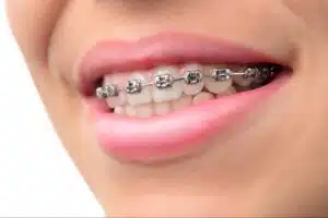 Adult smiling with braces during orthodontic treatment in Ukiah CA