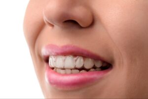 Adult wearing clear aligners for adult orthodontic treatment in Ukiah CA