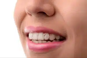Adult wearing clear aligners for adult orthodontic treatment in Ukiah CA