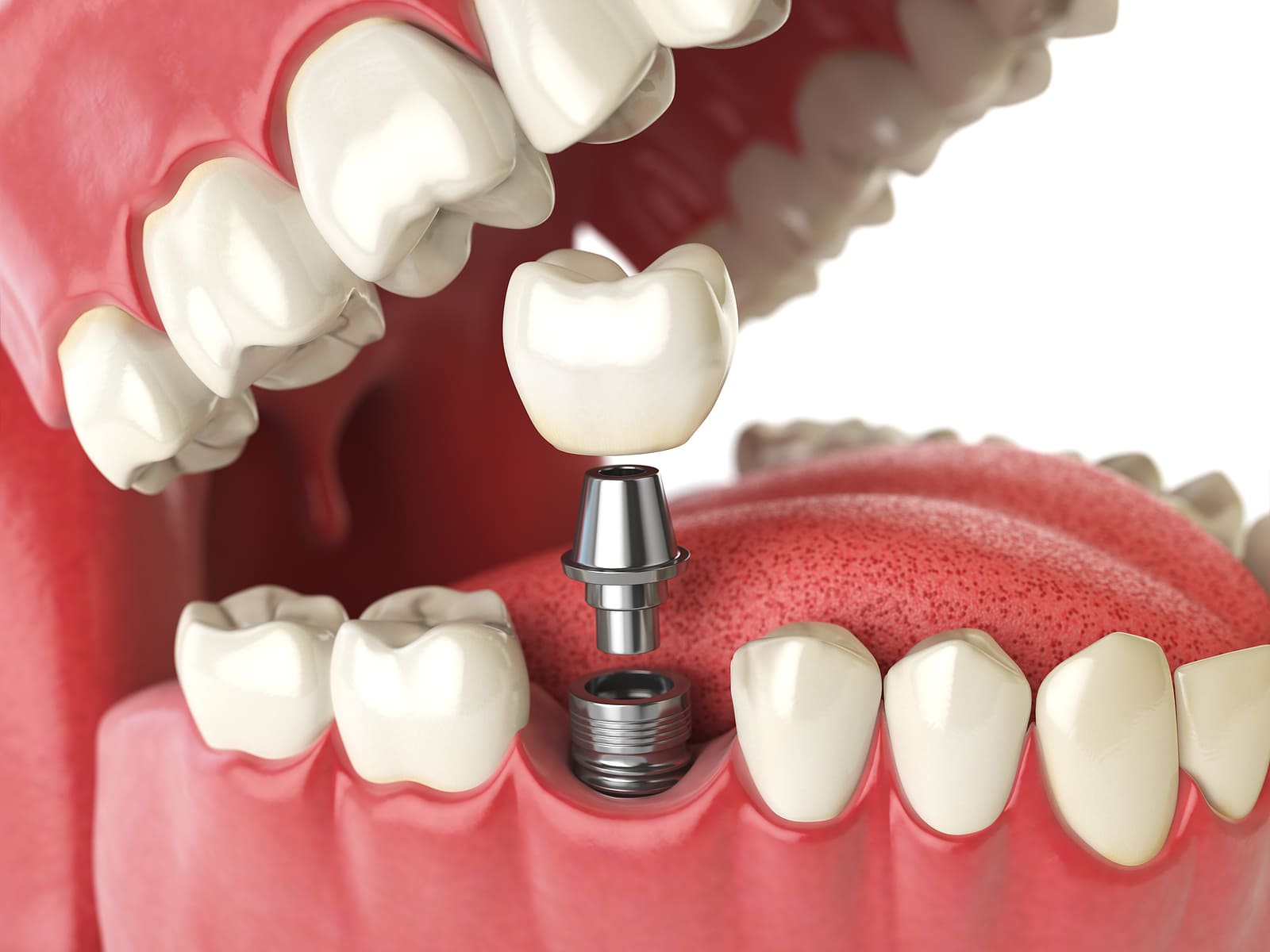 Dental implant model used during treatment planning in Ukiah CA