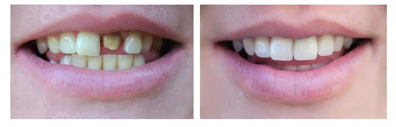before and after smile makeover with porcelain veneers in Ukiah CA