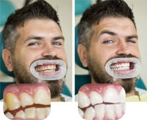 before and after professional teeth whitening results in Ukiah CA