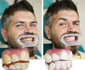 before and after professional teeth whitening results in Ukiah CA